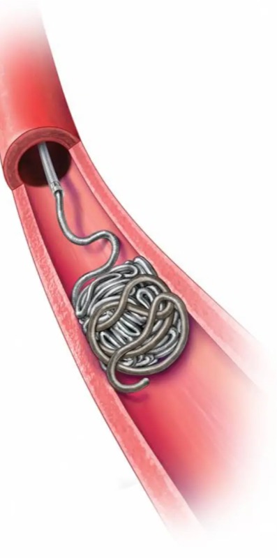 Microcatheter inside a blood vessel — illustration of the device used during TEMMA